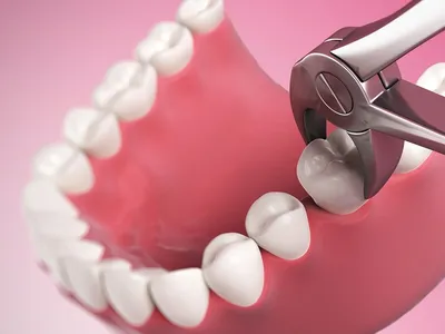 ᐈ Удаление 8 зуба мудрости Позняки ✔️ Стоматологический Центр