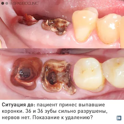 Новая неделя - новые зубы у моих пациентов 😁 Короновали две нижние шестерки  спустя 3 (примерно) месяца после имплантации двумя… | Instagram