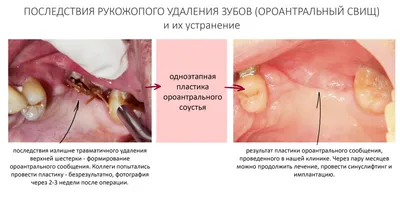 Герметизация фиссур зубов у детей: зачем нужна процедура