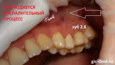 Удаление молочных зубов - «Молочные зубы у детей не всегда выпадают сами.  Корни молочных зубов, которые не рассасываются. Удаление зубов ребенку дома  (попытки), у стоматолога и под седацией» | отзывы