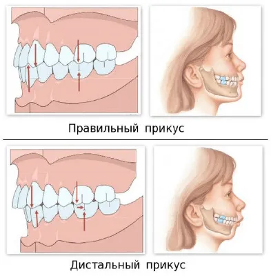 Смена молочных зубов: что нужно знать о прикусе, профилактике и «шестерках»