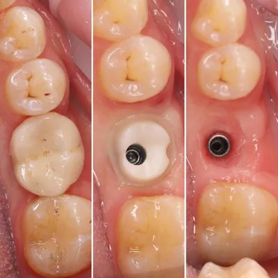 Берегите «шестерки» еще до шести лет - стоматологический блог Sirius-Dent