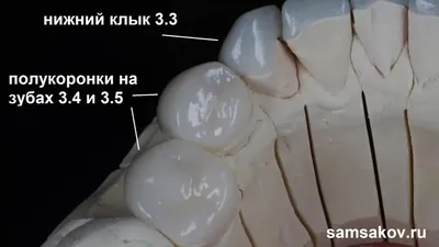Имплантация зуба Dentium с десневой пластикой | Стоматология СТУДИЯ УЛЫБОК  г. Сочи | Дзен