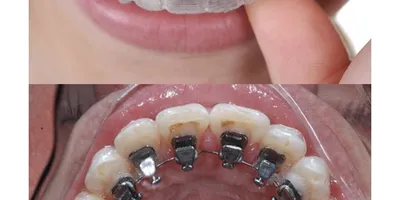 Клинический случай лечения первых постоянных зубов у детей» — Яндекс Кью