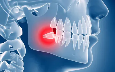 Зуб мудрости – что это такое? - Стоматология \"Скаковский\"