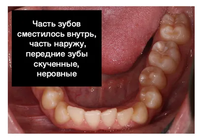 Нужно ли удалять зубы мудрости если болит зуб мудрости: мнение стоматолога