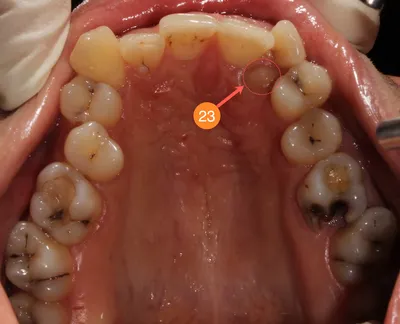 История одной улыбки или рассказ о том как даже «зуб мудрости» пригодился  :: NORD DENTAL — сеть клиник семейной стоматологии на севере Петербурга