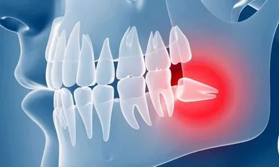 Зубы мудрости: что это, зачем нужны и можно ли удалять зубы восьмерки