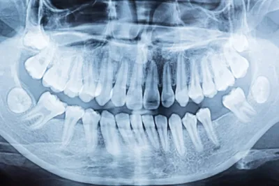 Удаление зуба мудрости одна из необходимых услуг хирурга
