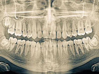 Нужно ли удалять зубы мудрости до установки брекетов? | Блог  стоматологической клинки Ликс Дент