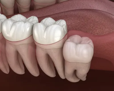 Удаление зубов мудрости Санкт-Петербург - Стоматологическая клиника  \"Галерея Улыбок\"