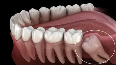 Файл:Зубы мудрости.png — Википедия