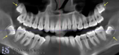 Зубы мудрости: когда и как удаляют, противопоказания