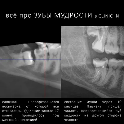 Зуб мудрости растет в щеку и болит - Стоматология в Томске