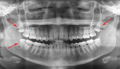 Корень Зуба Мудрости Сколько Их Восьмерка Восьмой ЛюмиДент