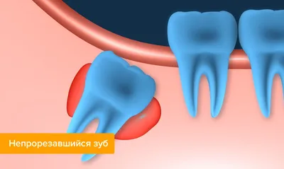Зуб мудрости - вся правда! Зачем нам нужны зубы мудрости | Дентал ТВ -  YouTube