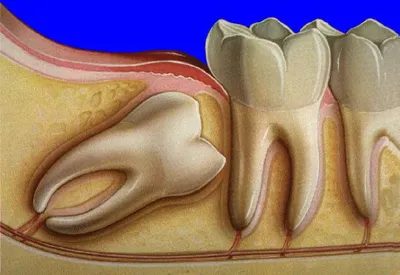 Зуб мудрости — лечить или удалять - энциклопедия Ochkov.net