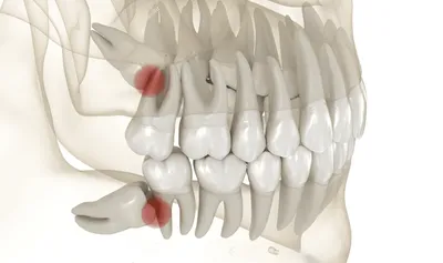 Зуб мудрости — лучше лечить или удалять?