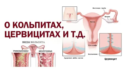 Зуд наружных половых органов | Доктор Елена Березовская
